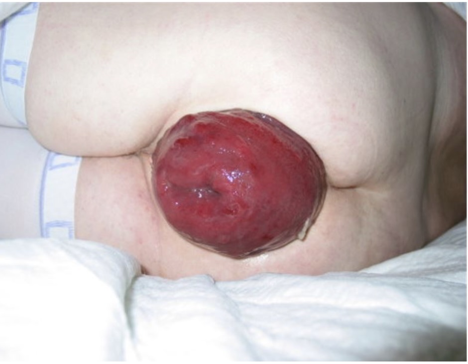 Rectal Prolapse and Fecal incontinence treatment